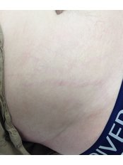 Stretch Marks Removal CO2 Laser - Sheffield Aesthetics & Laser Clinic