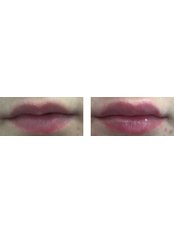 Lip Augmentation - Cosmetic Heaven