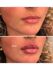 Lip Augmentation - My Cosmedica