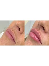 Lip Augmentation - Clinetics Medispa