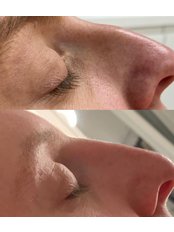 Non-Surgical Nose Job - Clinetics Medispa