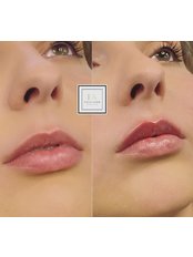 Lip Filler - Precision The Aesthetics Clinic