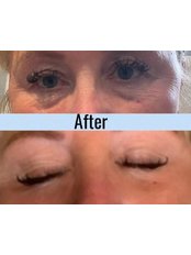 5 point Non-Surgical Facelift (Infini Aquabooster) - Glow Aesthetics