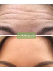 Treatment for Wrinkles - Charismetics
