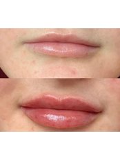  Lip Enhancement - Day Aesthetics
