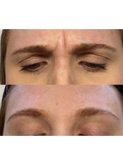 Anti Wrinkle Injections (1 Area) - Day Aesthetics