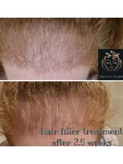 Hair Loss Treatment - Derma-Scape