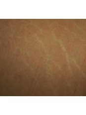 Stretch Marks Removal - Cosmedic Skin Clinic