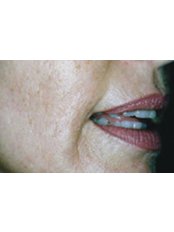 Dermaroller™ - Cosmedic Skin Clinic