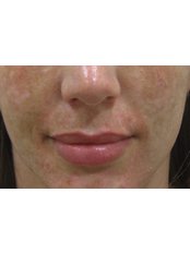 Acne Treatment - Cosmedic Skin Clinic