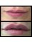 Beauty Health Aesthetics Ltd - Lip Fillers 