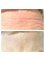 Beauty Health Aesthetics Ltd - Wrinkle Reducing Injections Before & After 
