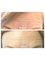 Beauty Health Aesthetics Ltd - Wrinkle Reducing Injections Before & After 