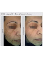Pigmentation Treatment- Cosmelan® - Tara Skin Clinic