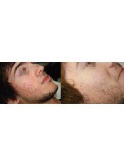 Acne Treatment - Tara Skin Clinic
