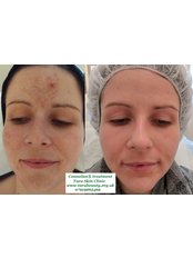 Pigmentation Treatment  - Tara Skin Clinic
