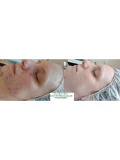 Acne Treatment - Tara Skin Clinic