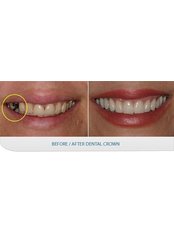 Dental Crowns - Dr Alison J Brown BDS