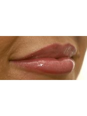 Lip Augmentation - Dr Alison J Brown BDS