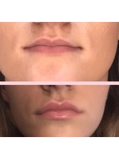 Lip Augmentation - Sk1n Aesthetics Clinic