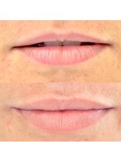 Lip Augmentation - Dr Marjan Goodacre