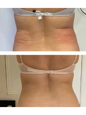 CoolSculpting® - Light Touch Clinic