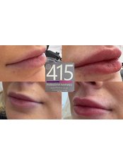 Lip Augmentation - 415 Professional Aesthetics