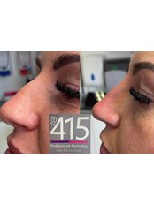 Non-Surgical Nose Job - 415 Professional Aesthetics
