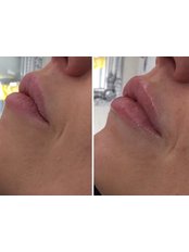 Lip Enhancement - City Aesthetics Clinic