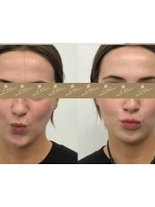Lip Augmentation - Dr Matla's Aesthetics