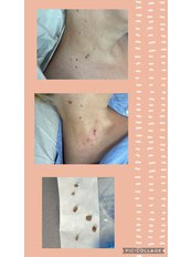 Skin Tag Removal - The Aesthetic Treatment Rooms