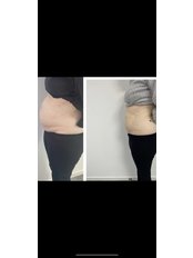 Fat Reduction Injections - The Aesthetic Treatment Rooms