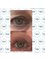 Aesthetic Beauty by Jules - plasma eyelid tightening 