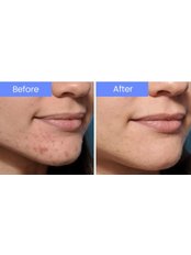Microneedling - The Look You Deserve