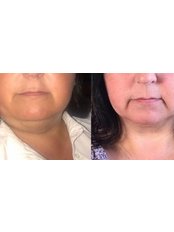 Fat Reduction Injections - Glow Aesthetics And Beauty
