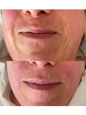Dermal Fillers - Glow Aesthetics And Beauty