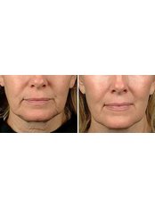 Radiofrequency Skin Tightening - Beautoxology