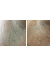 Skin Tag Removal - Beautoxology