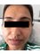 Aesthetica Skin Clinic - Lower face HIFU 