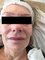 Aesthetica Skin Clinic - HIFU - Lower face lift 