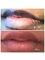 Aesthetica Skin Clinic - Lip Filler 