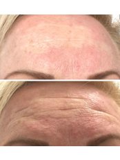 Treatment for Wrinkles - Bath Street Cosmetic
