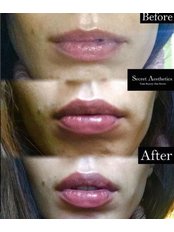 Lip Augmentation - Sky Clinic