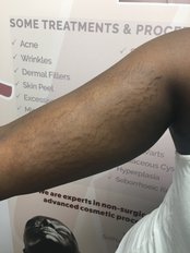 Stretch Marks Removal - Skeendeep Medical Aesthetics Clinic