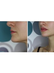 Lip Augmentation - Birmingham Private Clinic