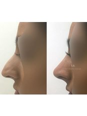 Non-Surgical Nose Job - Dr Majid Shah Aesthetics Birmingham