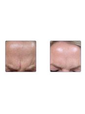 Treatment for Wrinkles- 1 Area - Skin Made Perfect