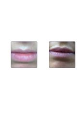 Lip Augmentation - Skin Made Perfect