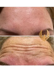 Treatment for Wrinkles - Feonix Aesthetics
