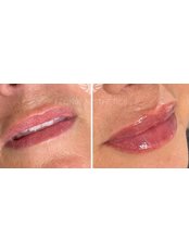 Lip Augmentation - Feonix Aesthetics